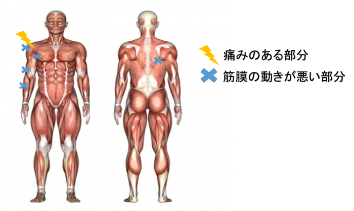 筋膜の動きの悪い部位を図示した画像