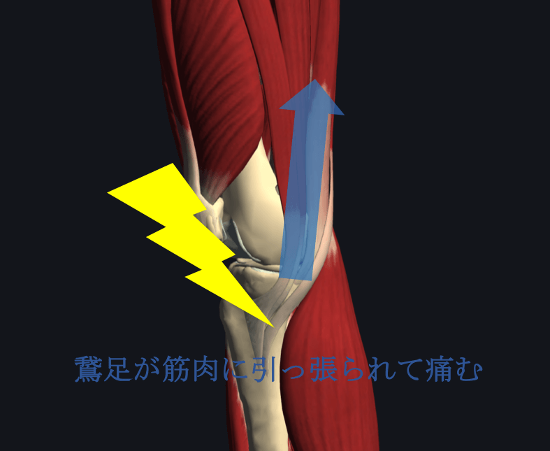 ランニング 膝 痛み 内側