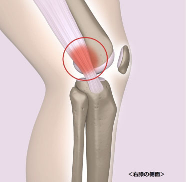 ランナー膝　筋膜リリース　原因