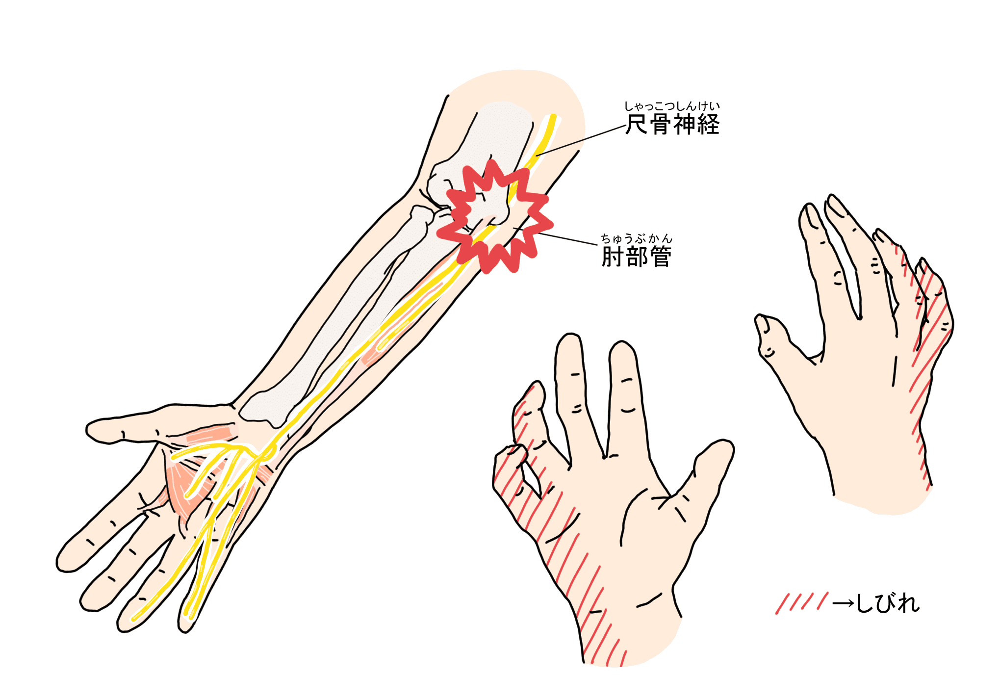 手首 から 肘 にかけて の 痛み