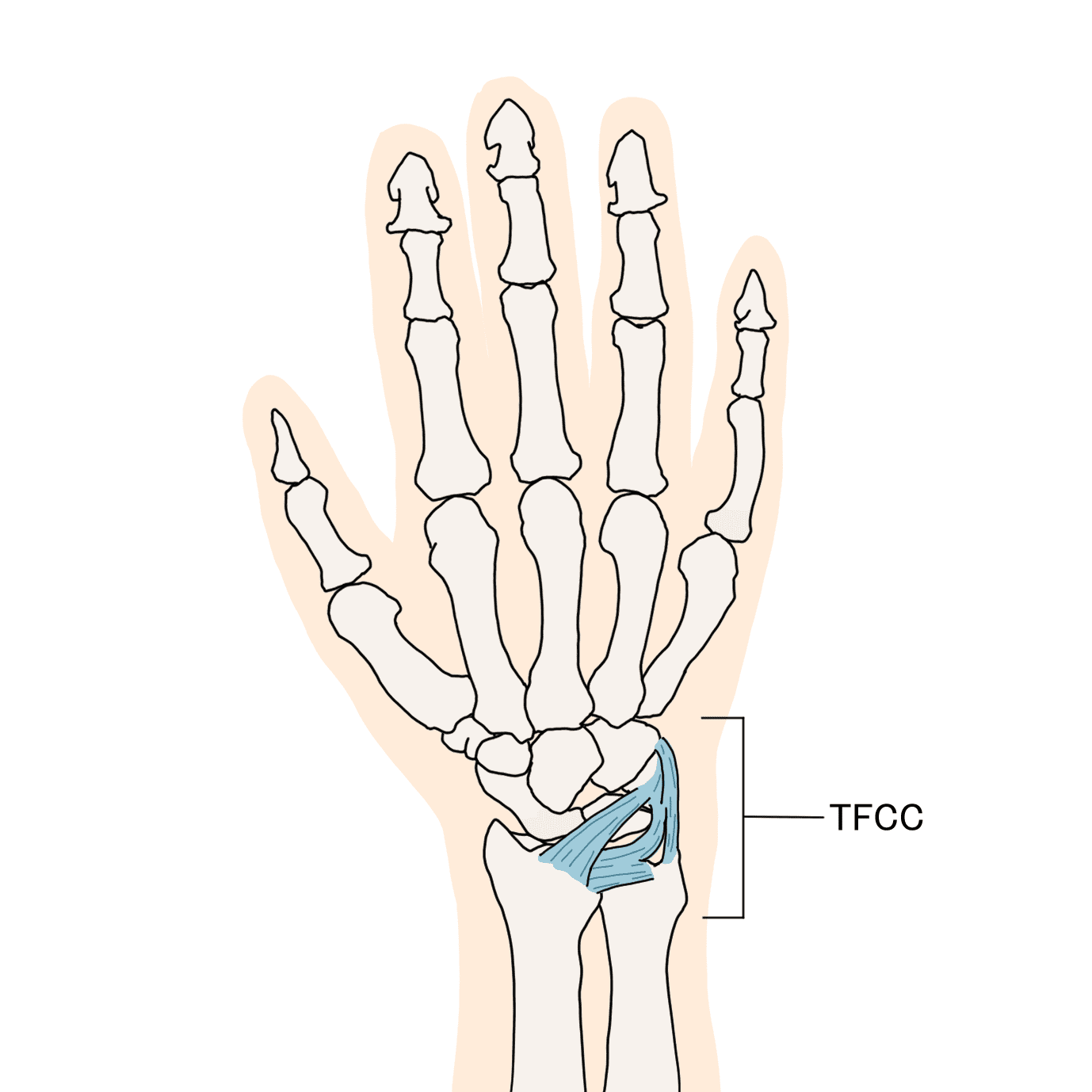 小指側の痛み　TFCC損傷