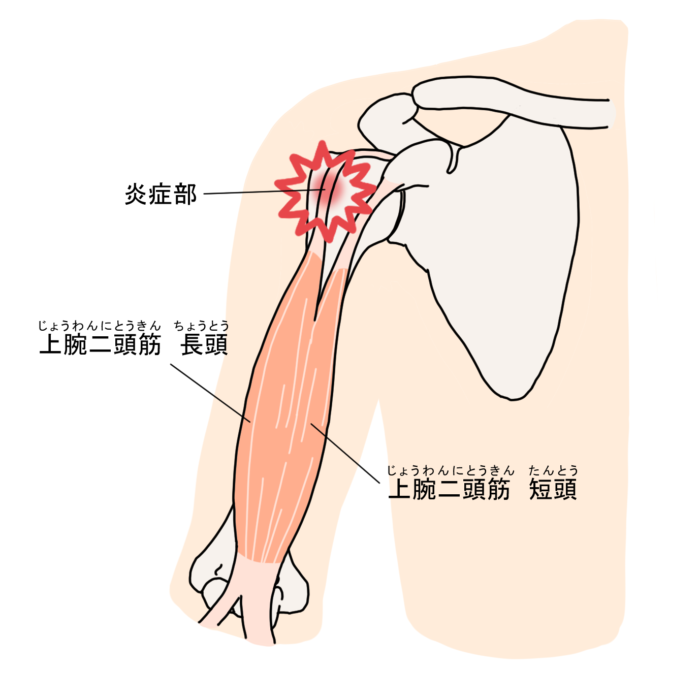 ベンチプレス 肩の付け根の痛み 原因 対処法　上腕二頭筋長頭腱