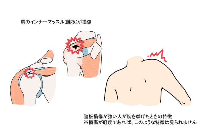 ベンチプレス 肩の付け根の痛み 原因 対処法　腱板損傷　断裂