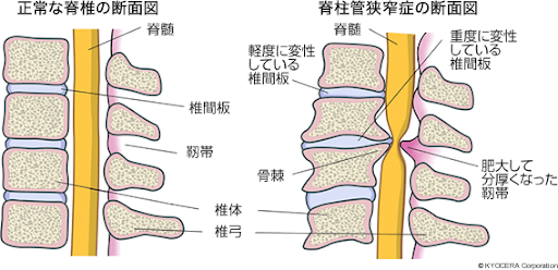 脊柱管狭窄症の断面図