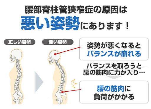 脊柱管狭窄症の原因は悪い姿勢